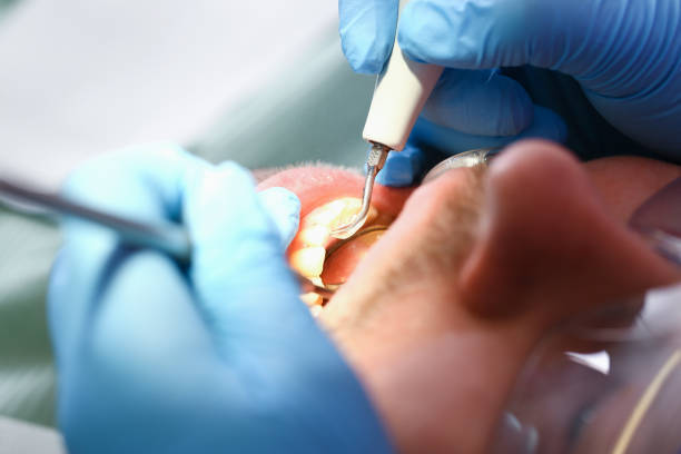 Best Emergency Tooth Extraction in Burton, MI