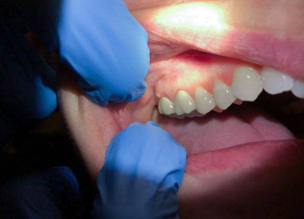 Best Emergency Root Canal Treatment in Burton, MI